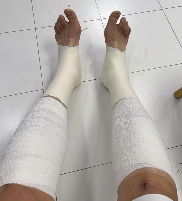 胜山西谁注意翟晓川赛后伤势？双腿拉伤绑满绷带，看着都残忍！|北京|篮板|比赛|王治郅|复出_新浪体育_新浪新闻